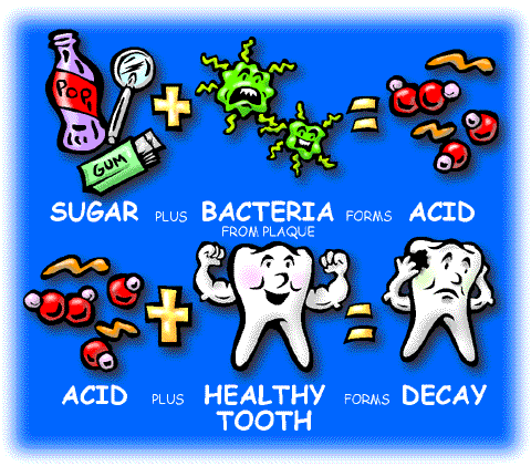 Picture shows process that teeth undergo in developing cavities and tooth decay. First, sugar (soda, gum, and candy) plus bacteria from plaque forms acid. Then the acid plus a healthy tooth forms decay.