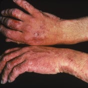 skin infection