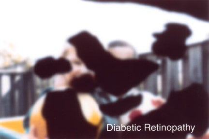 Image viewed under Diabetic Retinopathy