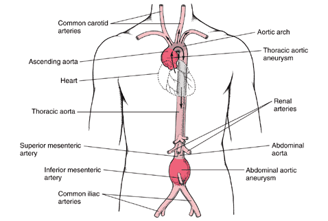 aneurysm definition. Basically aneurysms occur when