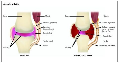 Diagram showing healthy joint and inflamed joint with arthritis