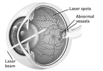 Image of laser Treatment