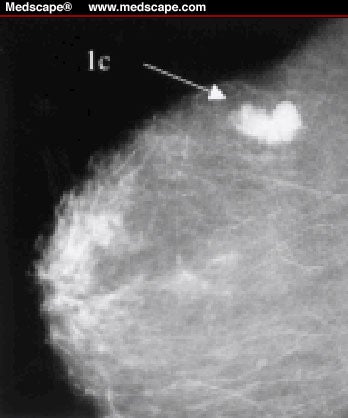 negative showing mass