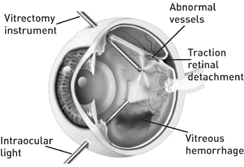 Image of a vitrectomy