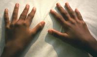 image shows swollen fingers