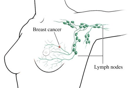 illustration of breast cancer