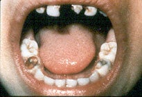 Picture of a child's mouth that is full of severe dental cavities, fillings, deteriorating teeth, etc.