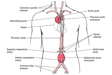 anatomical drawing of an aneurysm