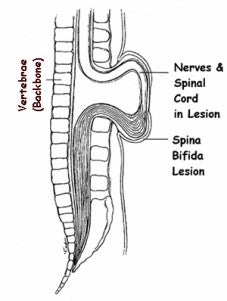 drawing of spina bifida