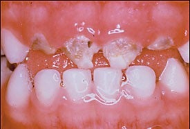 Early childhood caries in a child three years of age. Brown cavitations and breakdown of the anterior incisors are clearly visible.