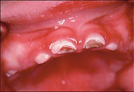 Gross cavitations in the erupting teeth of an infant.