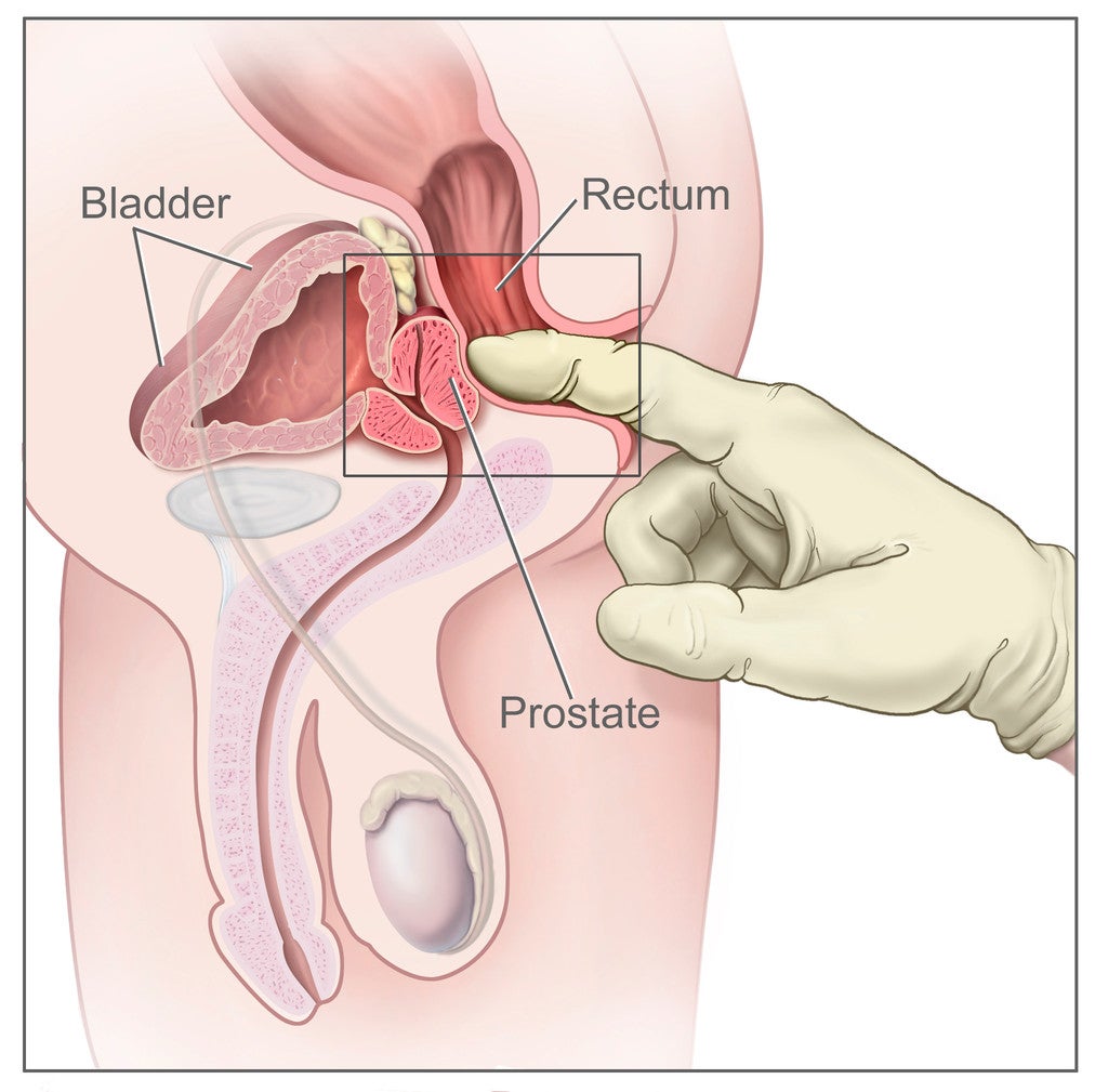 Image of a Digital Rectal Exam